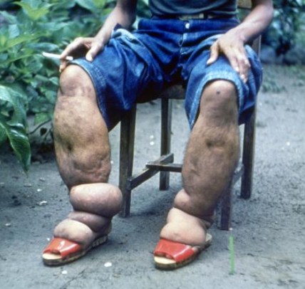 Elephantiasis